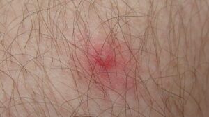 three-dead-in-california-after-contracting-tick-bite-disease