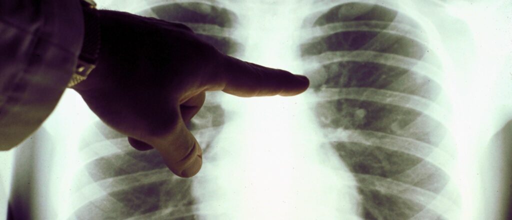 fact-check:-no,-lung-washing-cannot-reverse-permanent-damage