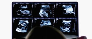 abortions-drop-by-12,000-after-red-state-heartbeat-protection-law-takes-effect