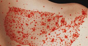 scientists-find-measles-likely-to-become-endemic-in-the-us-over-next-20-years