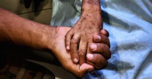 the-grave-long-term-effects-of-the-gaza-malnutrition-crisis