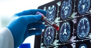 blood-tests-for-alzheimer’s-are-here