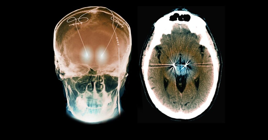 a-personalized-brain-implant-curbed-a-woman’s-ocd