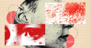 you-should-be-more-freaked-out-by-shingles