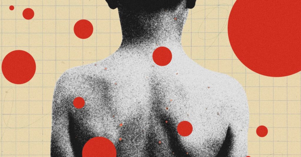 the-backward-logic-of-chickenpox-parties