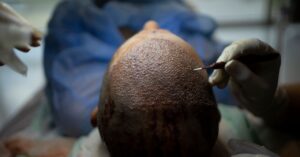 how-turkey-hacked-the-hair-transplant-industry