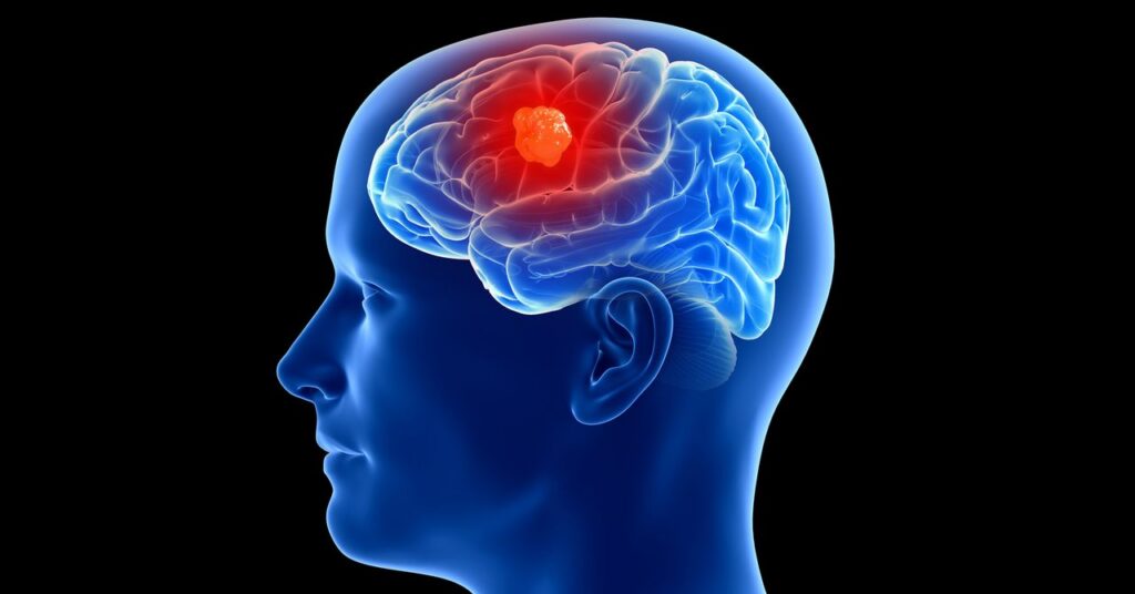 3-people-have-gotten-cancer-detecting-implants-in-their-brains