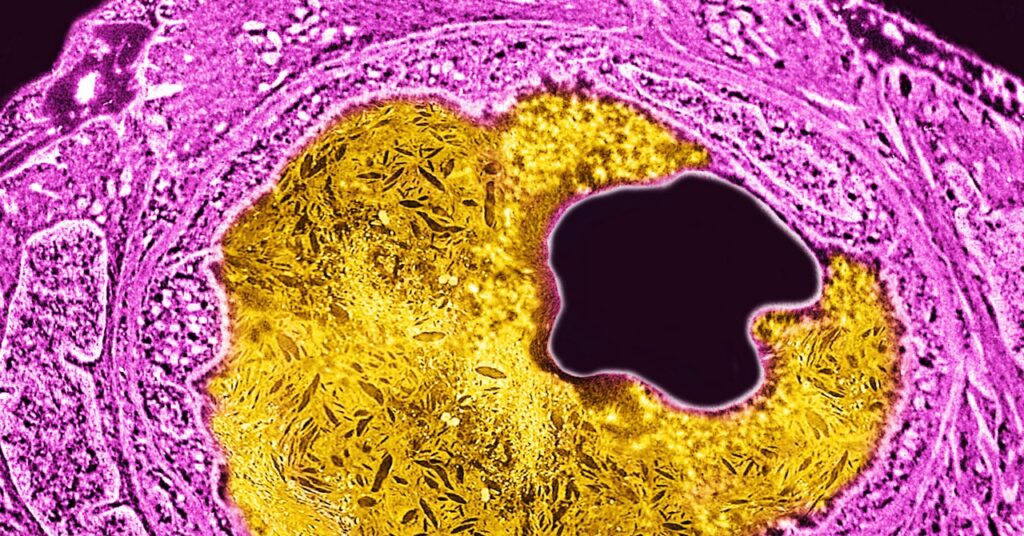 a-single-infusion-of-a-gene-editing-treatment-lowered-high-cholesterol