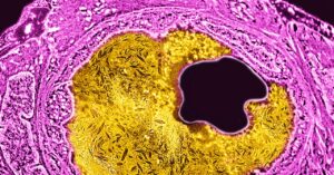 a-single-infusion-of-a-gene-editing-treatment-lowered-high-cholesterol