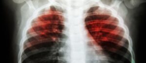 cdc-identifies-source-of-second-nationwide-tuberculosis-outbreak