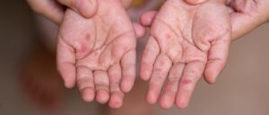 child-sent-to-daycare-spreads-potentially-deadly-illness-despite-quarantine-instructions