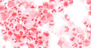 cdc-issues-alert-after-invasive-and-deadly-meningococcal-disease-rates-soar-in-us.